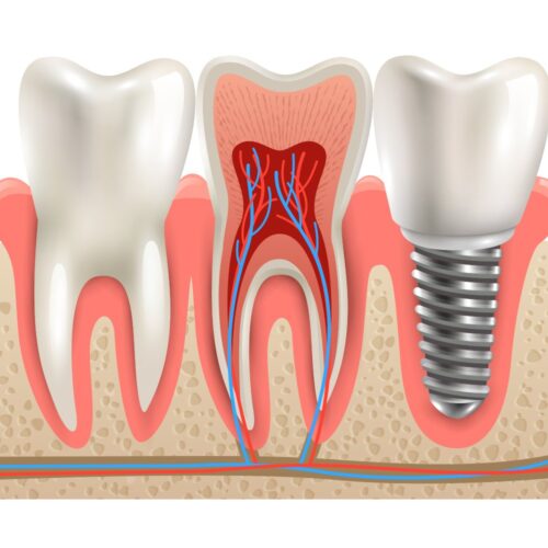 dalyan-beylikduzu-implant-nedir